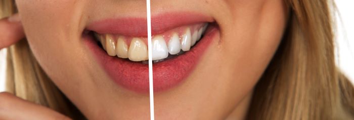 Professional Teeth Whitening Best